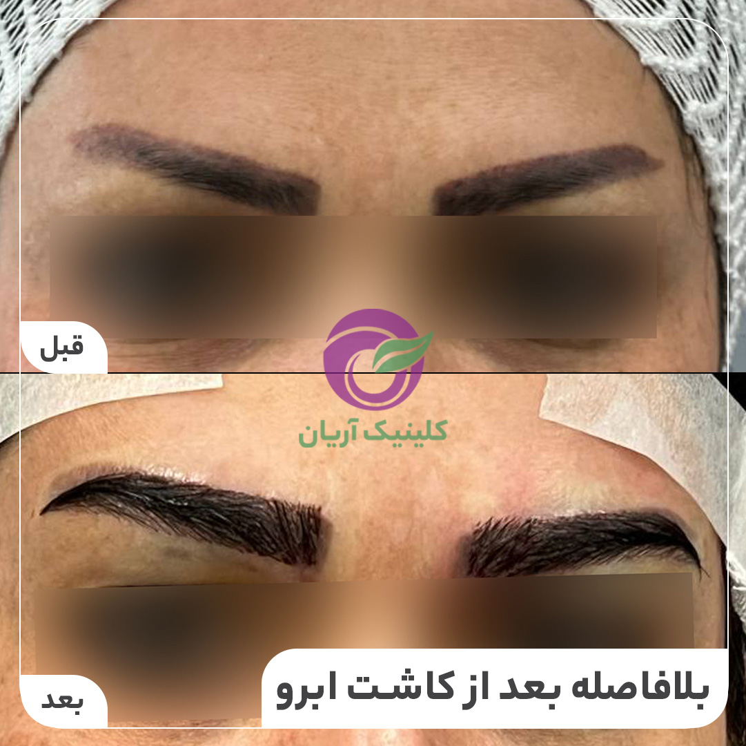 گالری فیلم کاشت ابرو